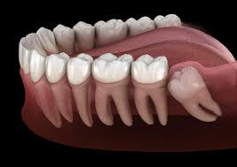 5 Signs You Need Wisdom Teeth Removal 1 5 Signs You Need Wisdom Teeth Removal